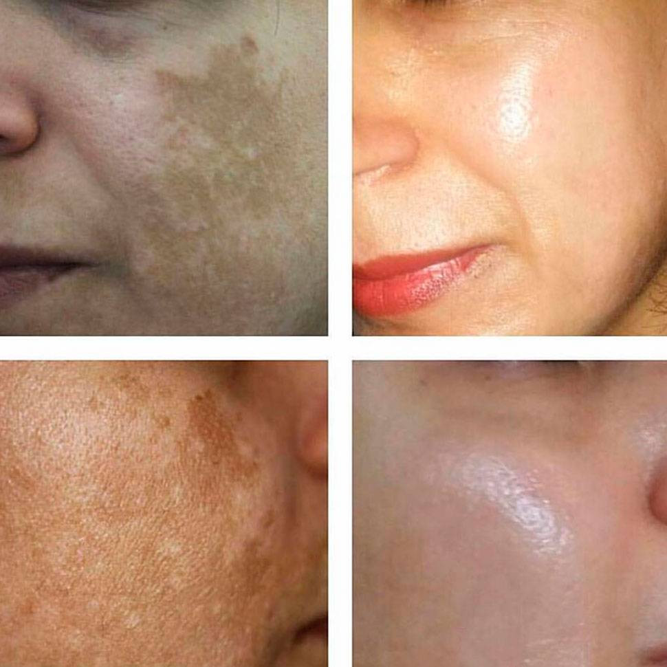 Пилинг для борьбы с возрастными изменениями кожи Genosys SRS Skin Renewal Peeling System