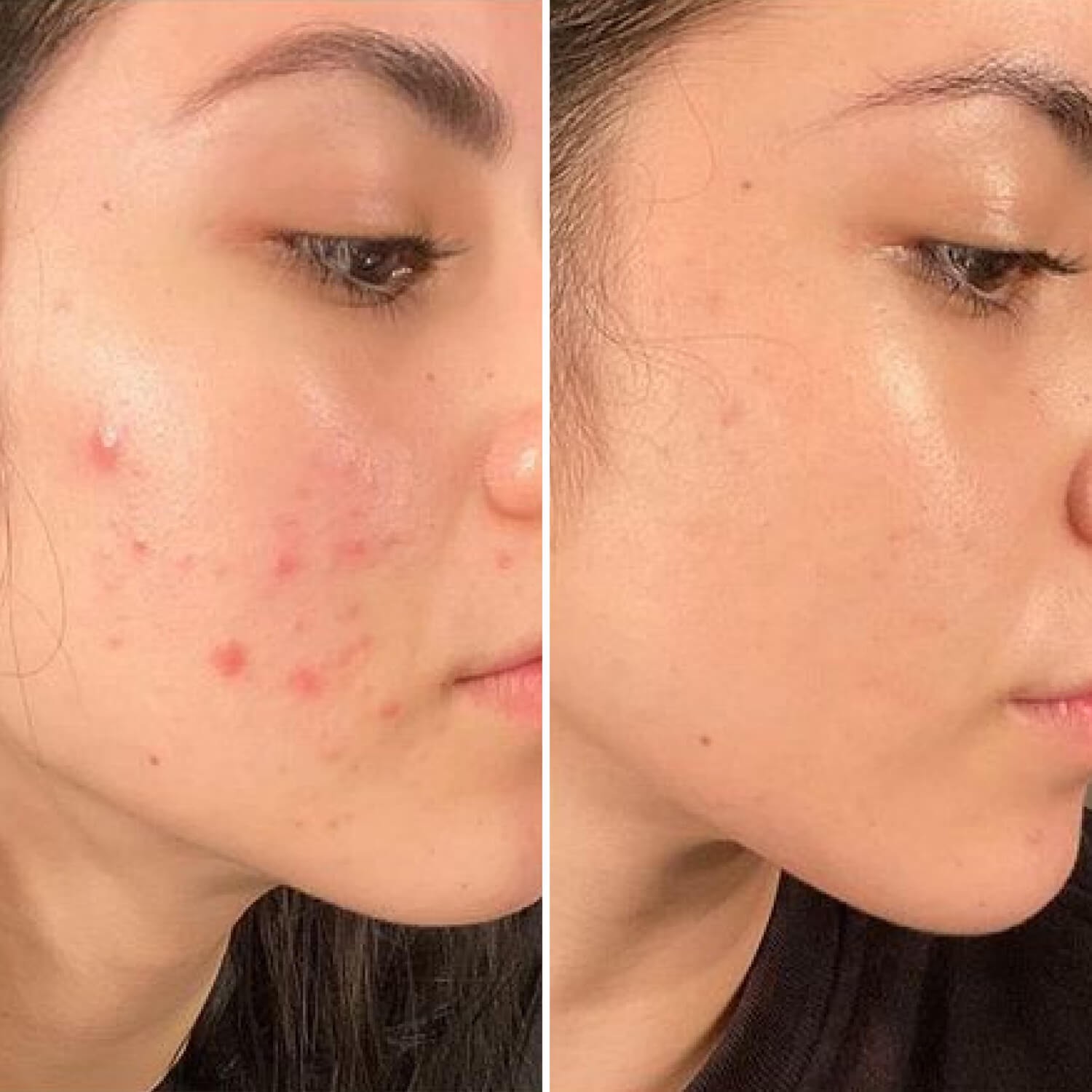 Сироватка від прищів та постакне Robeauty Me Niacinamide 4% + Vitamine Ferment
